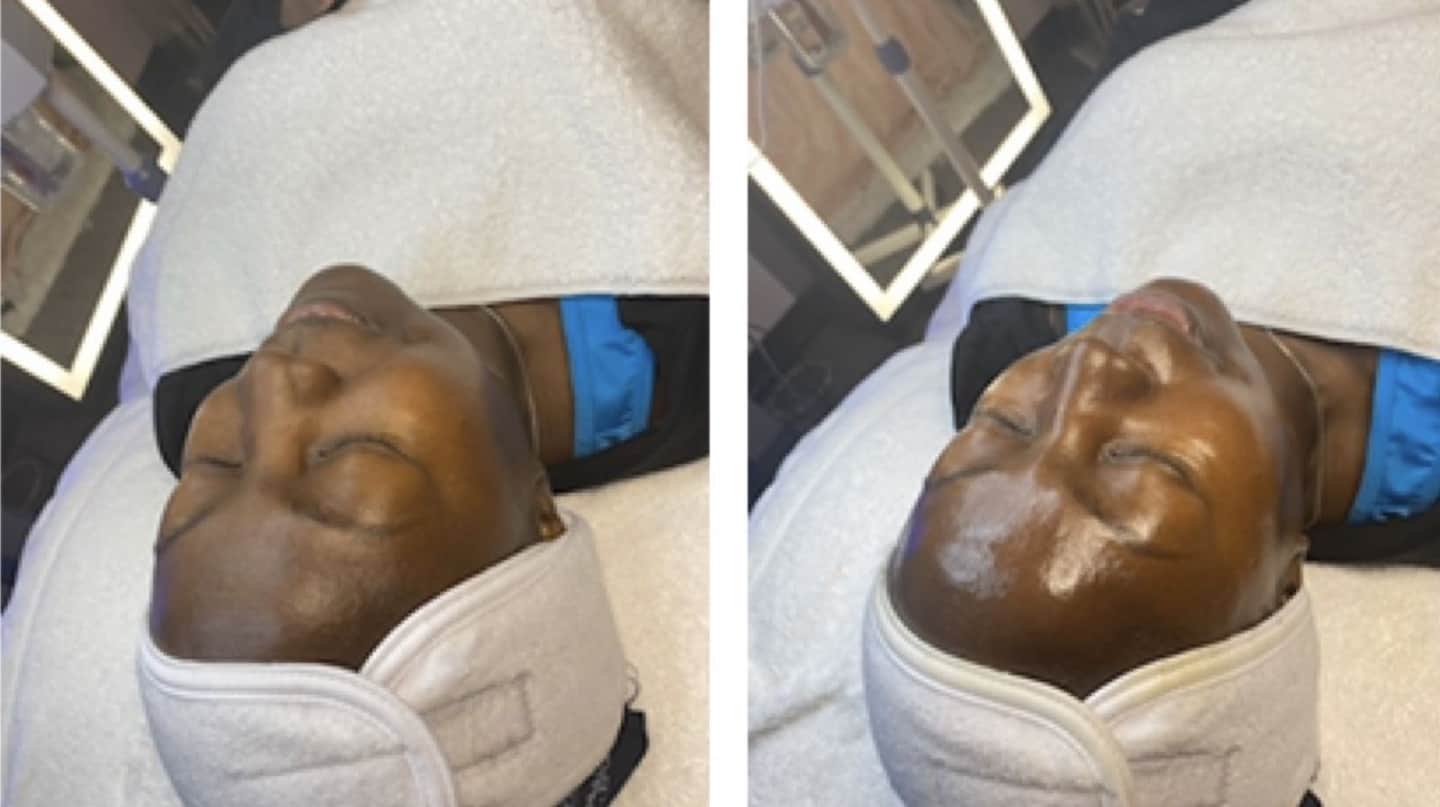 Skin glow treatment
