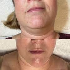 Skin transformation