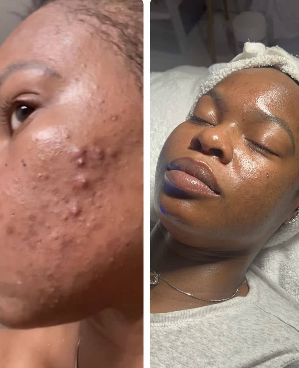 Acne treatment before and after