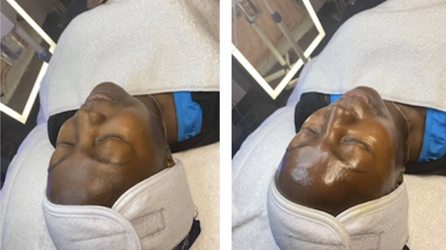 Skin glow treatment