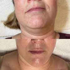 Skin transformation