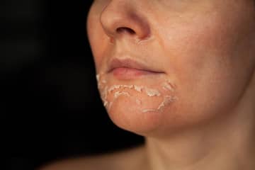 Chemical peel