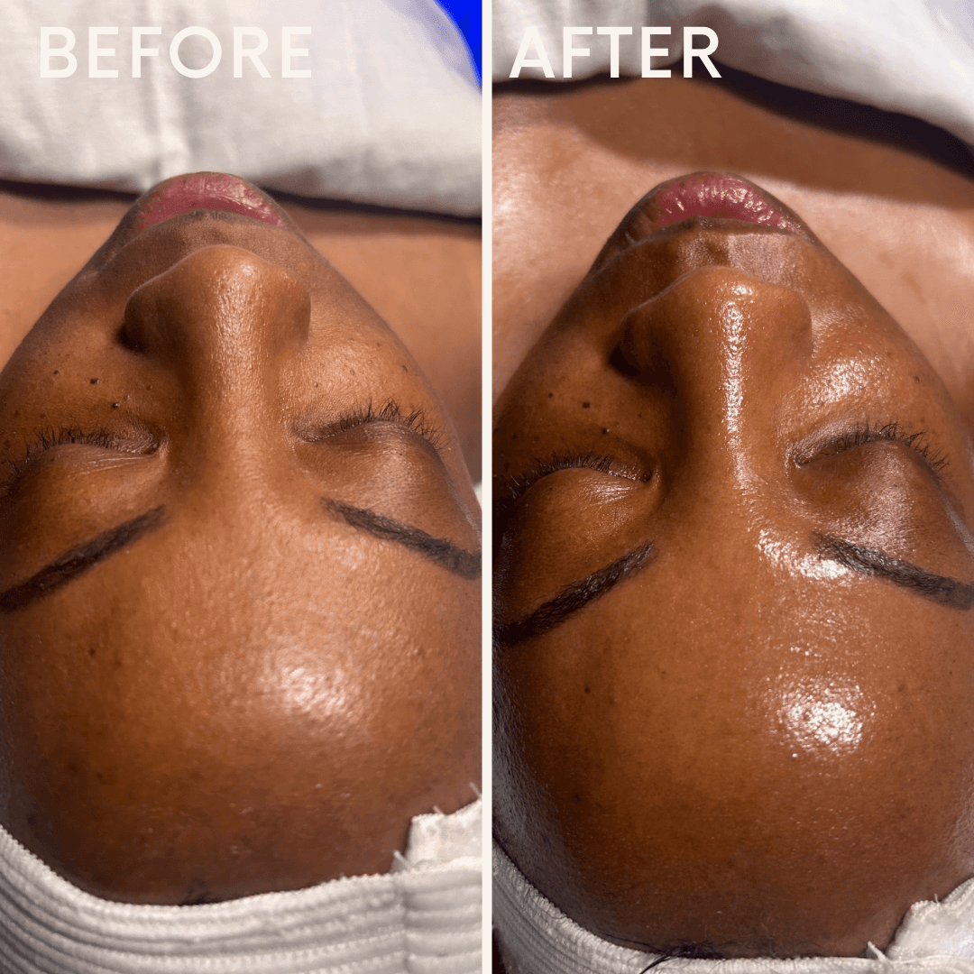 Facial before and after