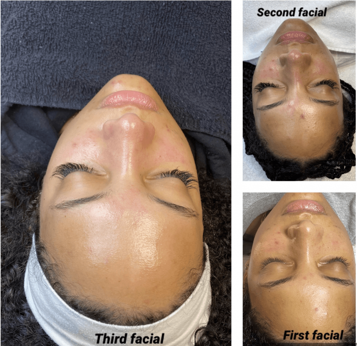 Facial series results