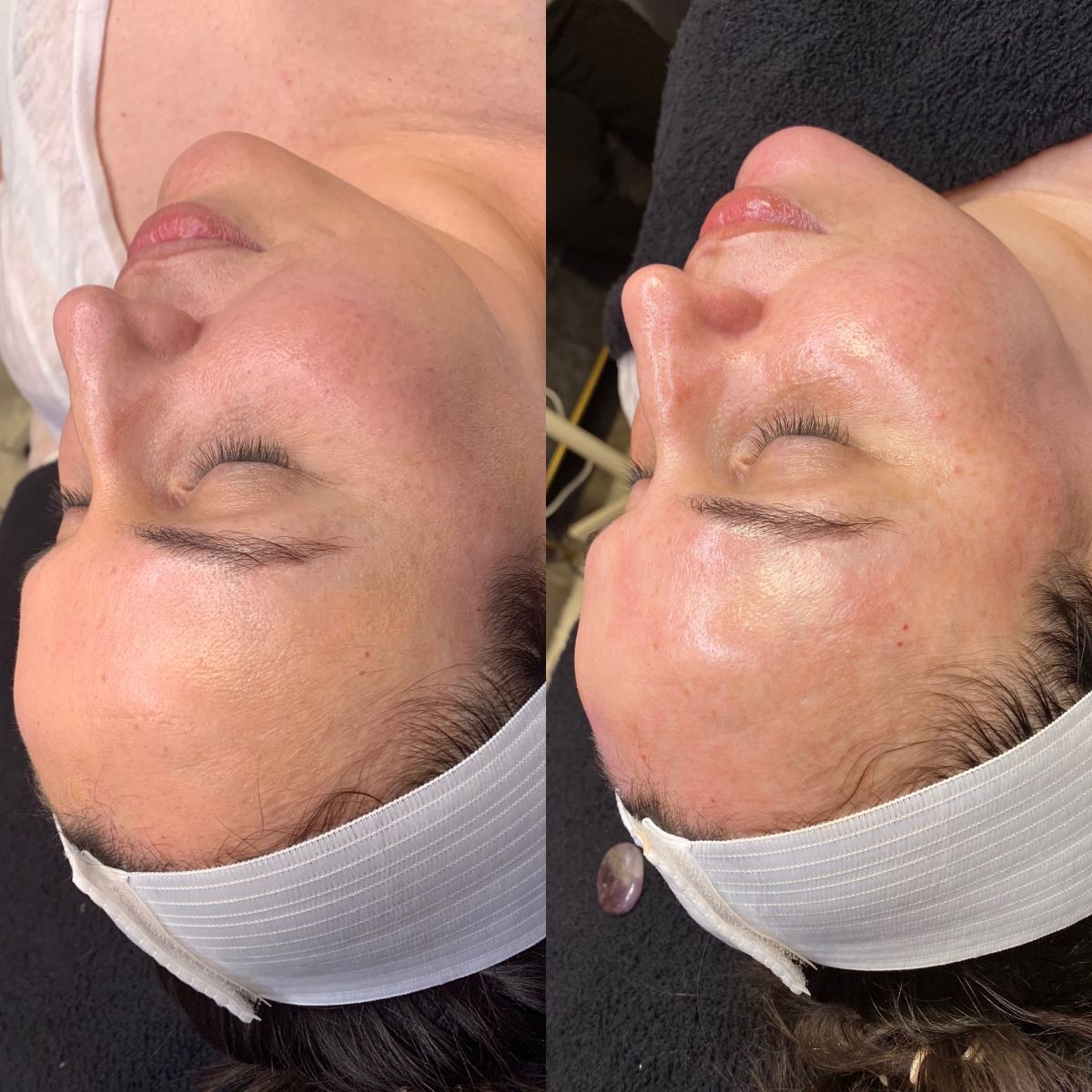 Skin Treatment Before and After