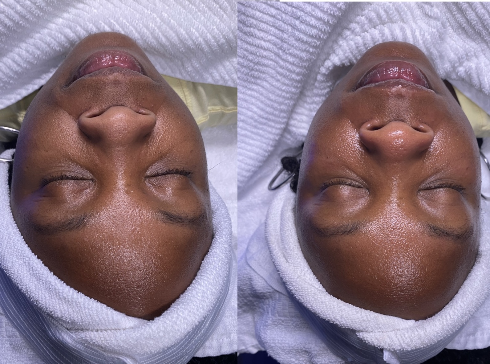 Facial Treatment Before and After