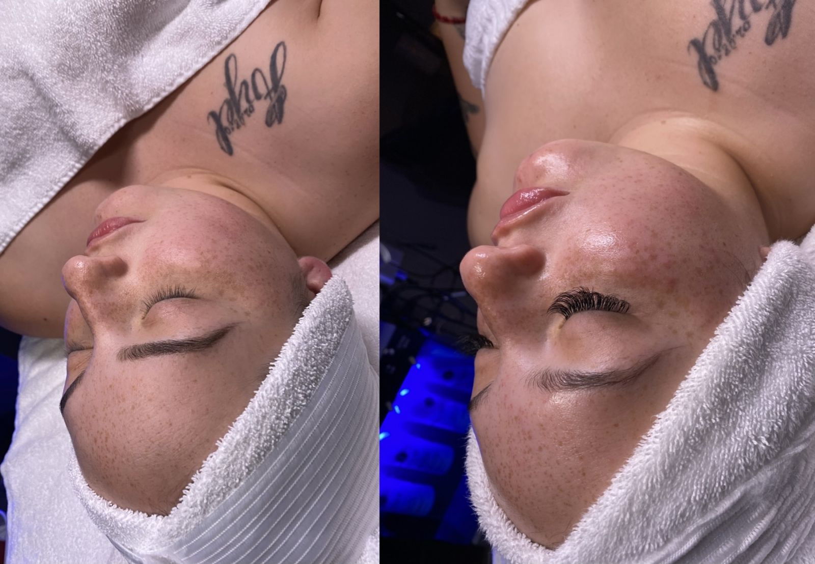 Facial Treatment Before and After