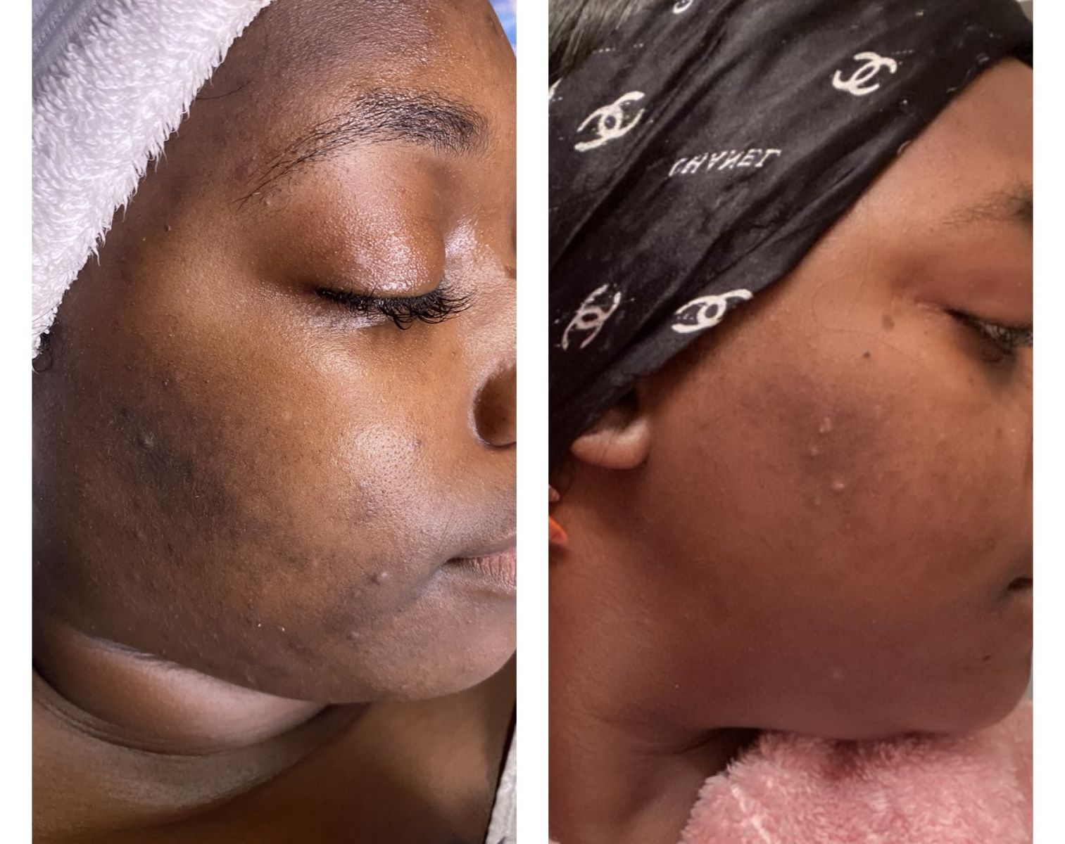 Facial Treatment Before and After