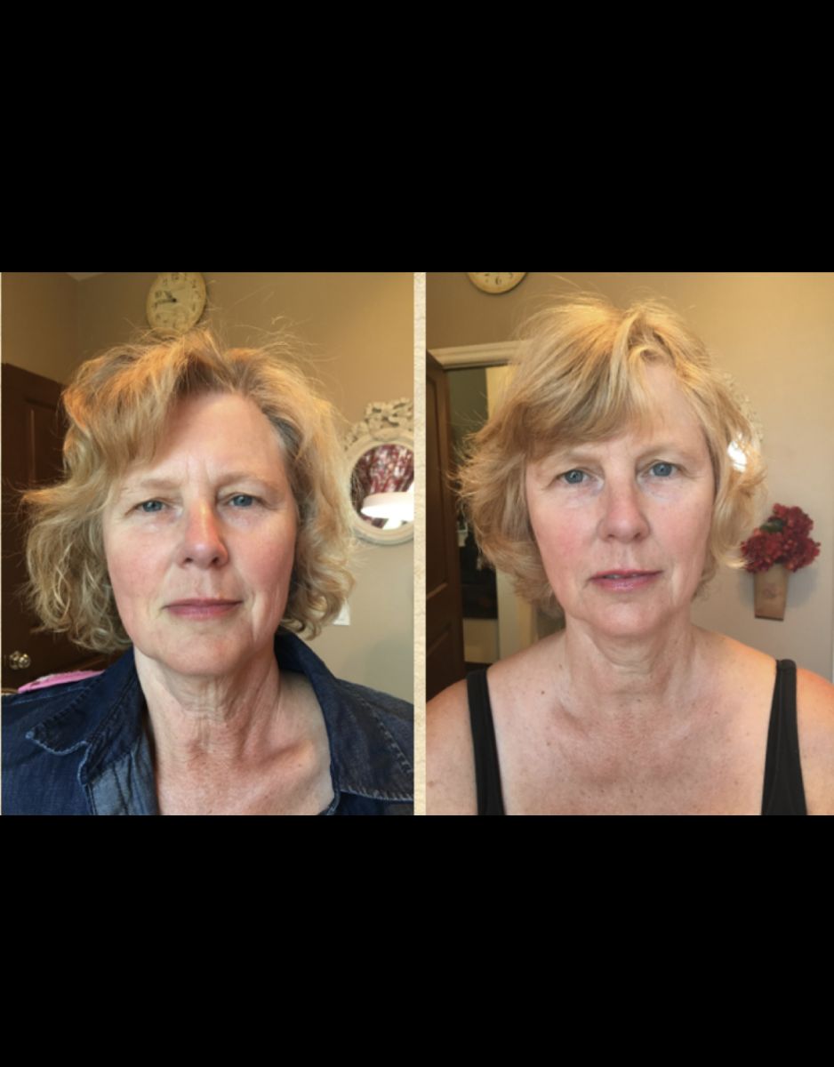 Facial Treatment Before and After