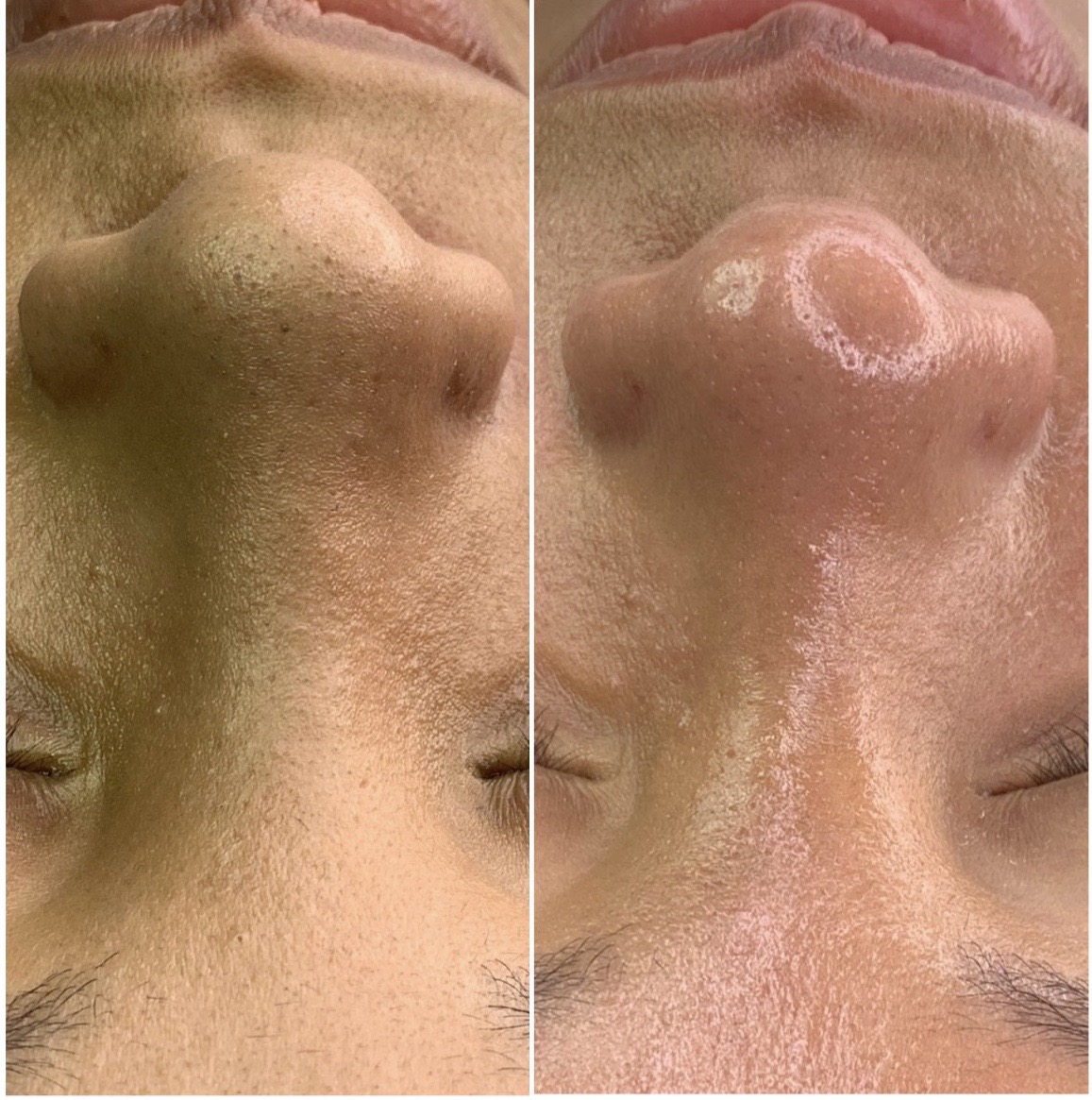 Facial Treatment Before and After