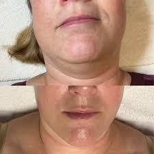 Facial Treatment Before and After