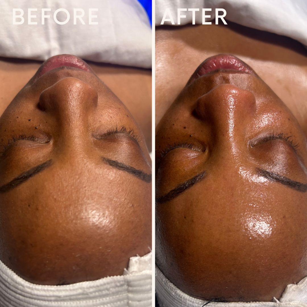 Facial Treatment Before and After