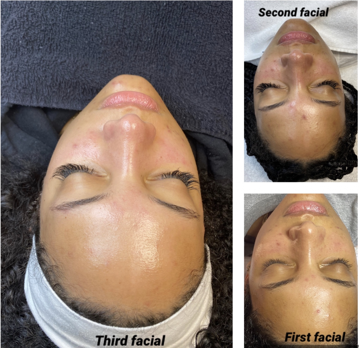 Facial Treatment Before and After